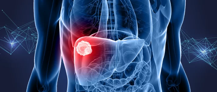 Liver Cancer